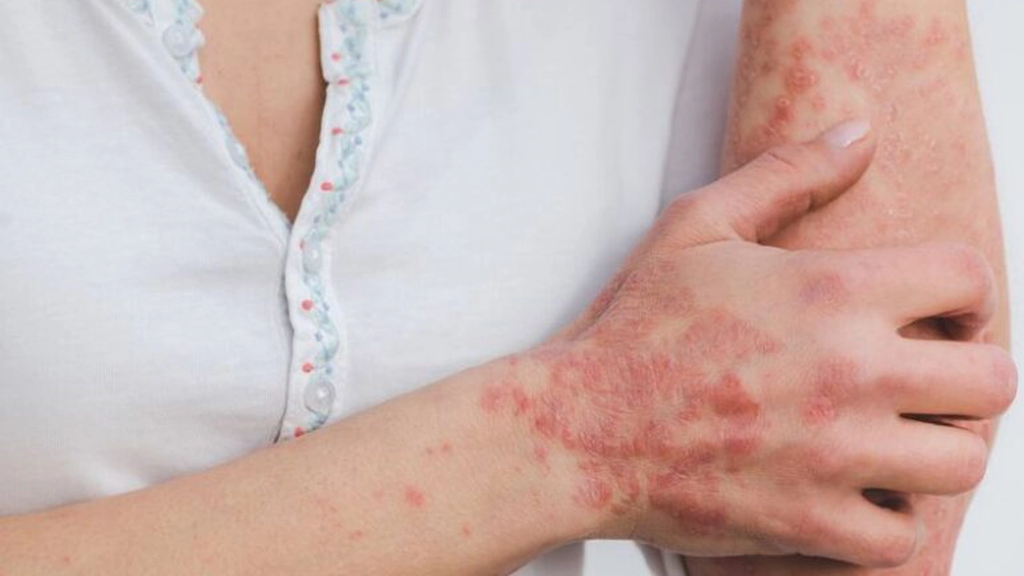 Leacuri bătrânești pentru psoriazis – Remedii naturiste pentru această afecțiune