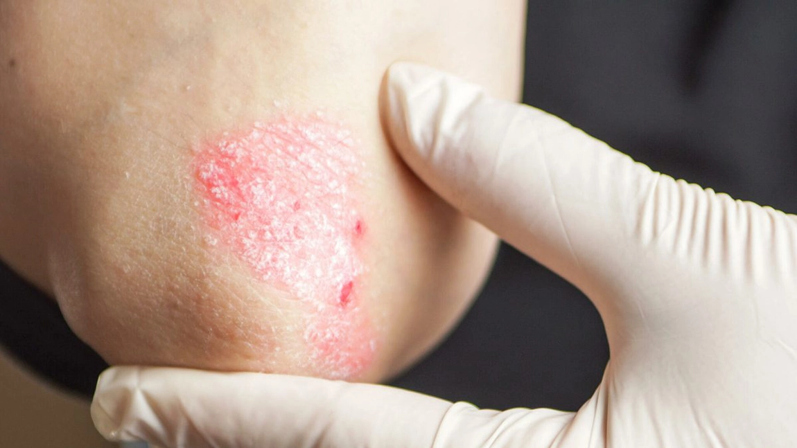 Tipuri de psoriazis poze: Principalele cauze care provoacă boala