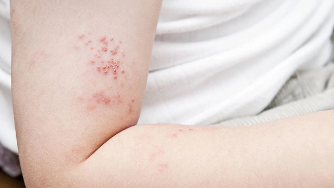 Zona zoster poze la început: Primele simptome care semnalează afecțiunea