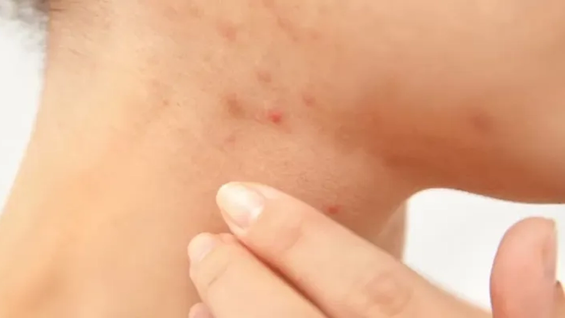 Scabie tratament rapid. Recomandările specialiștilor pentru a scăpa de boală acasă