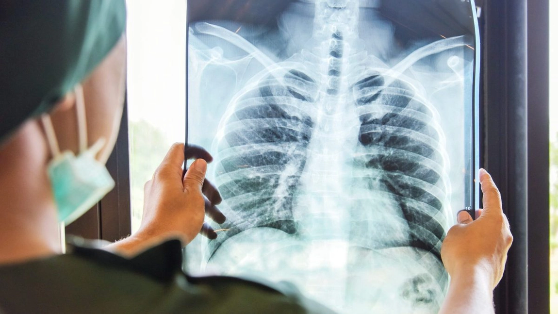 Cancer pulmonar ultima fază: simptome, cauze și tipuri