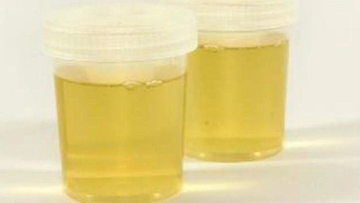 Urină galbenă ca lămâia ce înseamnă? Cu ce afecțiuni este asociat simptomul