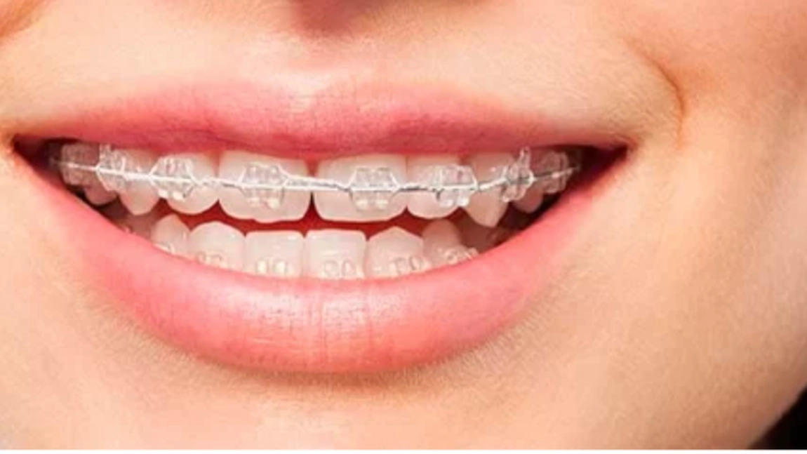 Cat costa un aparat dentar si cand ai nevoie, cu adevarat de acesta? Vezi ce recomanda specialistii