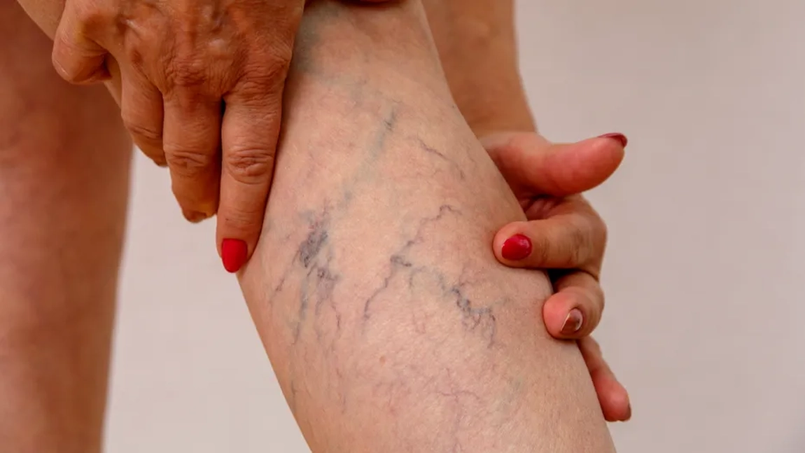 Pastile pentru varice. Cum să scapi de defectul cosmetic