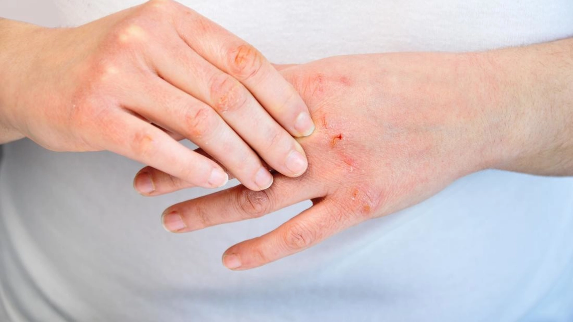 Psoriazis vulgar. Prin ce metodă poți scăpa de această boală autoimună