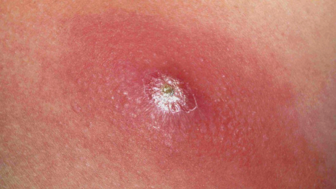 Infecția cu stafilococ auriu. Cauze, simptome, tratament și poze cu temuta bacterie