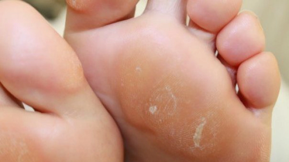 Trei creme naturale pentru bătături. Iată cum să le prepari acasă