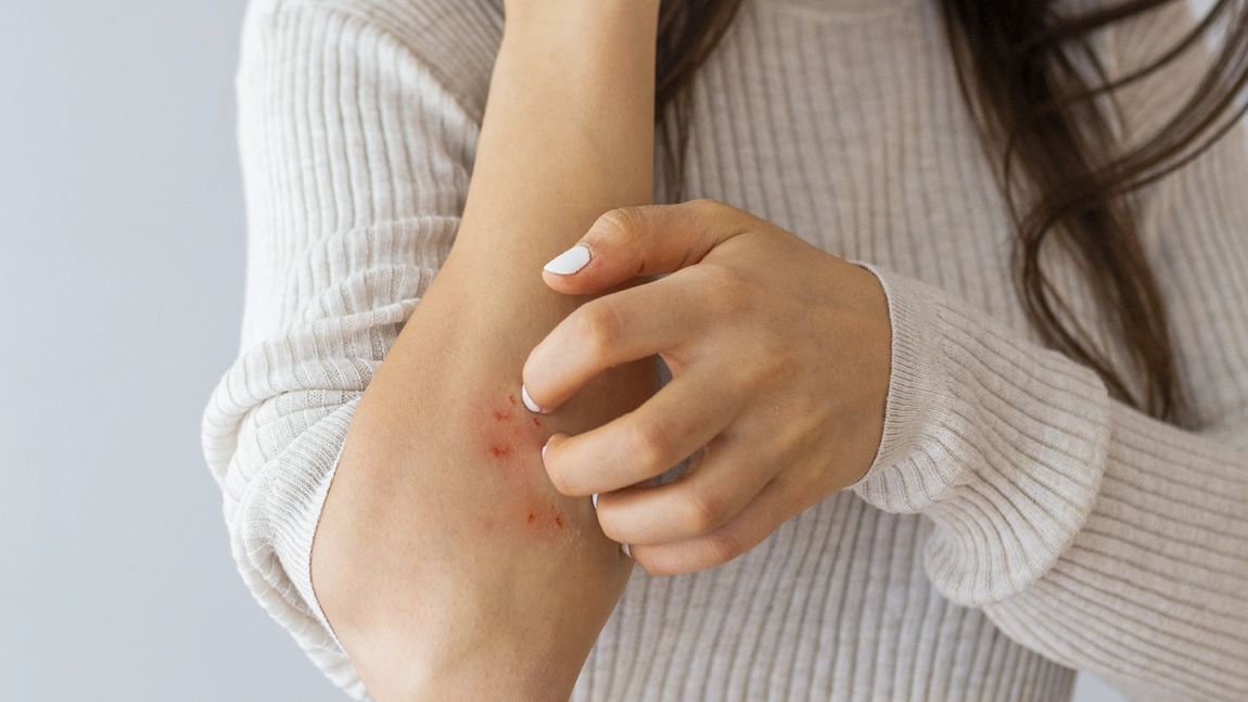 Ce este eczema și ce tratament recomandă medicii pentru ameliorarea simptomelor? Iată cum prepari un unguent eficient acasă