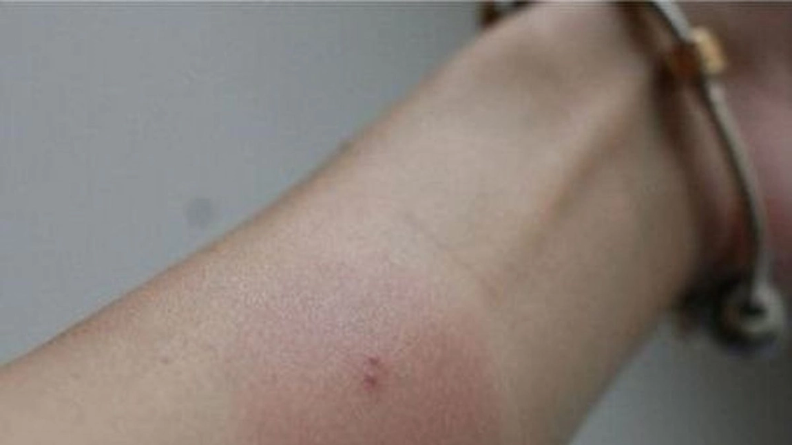 Înțepătură care se extinde. Infecții și reacții alergice provocate de insecte
