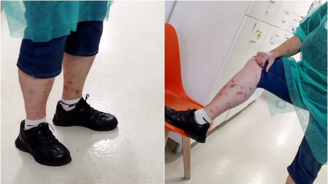 Ciupită de ploșnițe într-un hotel din România. A mers pentru tratamentul cu ape termale, însă a fost tratată cu ploșnițe