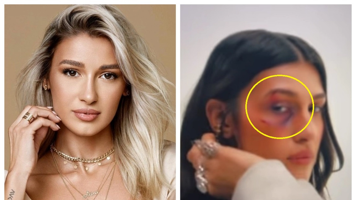 Alina Eremia s-a pozat cu ochiul vânăt și a distribuit fotografia pe Instagram. Ce s-a întâmplat în viața îndrăgitei artiste?