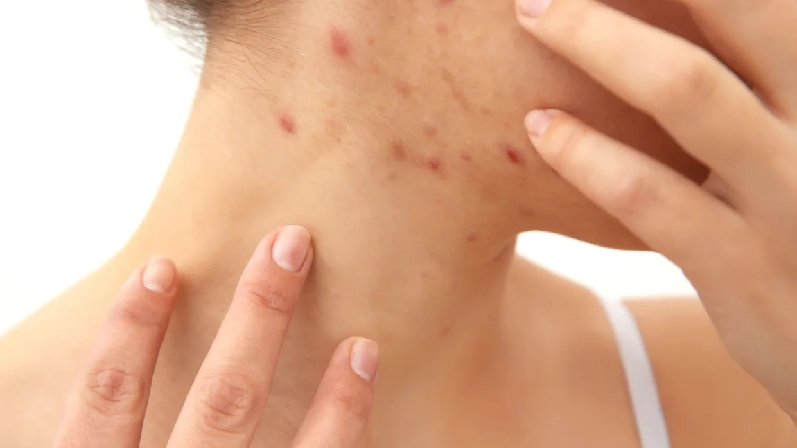 Boli de piele – poze. Cum să identifici afecțiunea în timp util