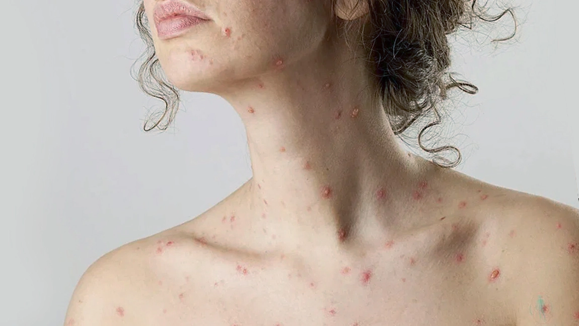 Poze - vărsat de vânt. Cât de contagioasă este afecțiunea?