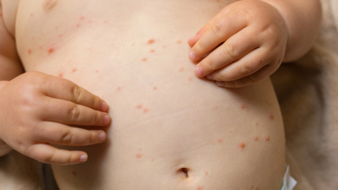 Varicela prima zi. Care sunt primele simptome provocate de virus