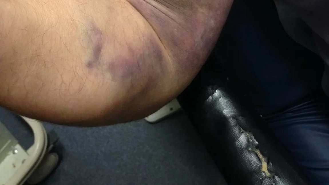 Ruptură musculară. Cum afectează incidentul calitatea vieții pacientului