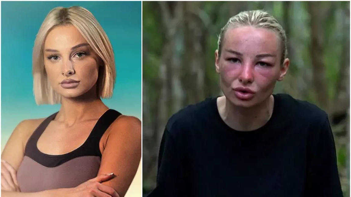 De ce fețele concurentelor de la Survivor s-au umflat? Un medic explică