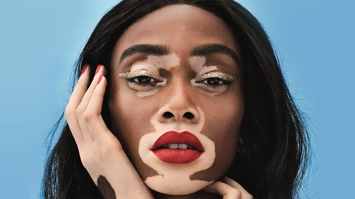 Vitiligo-poze. Din ce cauză apare afecțiunea dermatologică și cum să stopezi dezvoltarea acesteia?