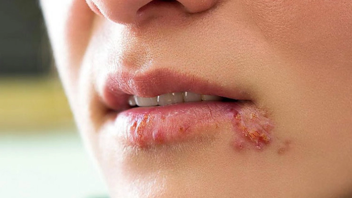 Herpes la gură - tratament rapid. Ce să aplici pe rană pentru a vindeca disconfortul?