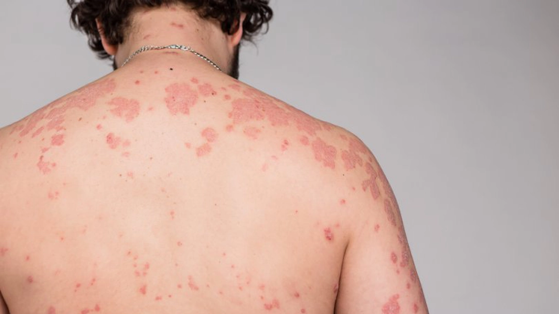 Poze cu boli de piele. Cele mai grave și frecvente afecțiuni dermatologice