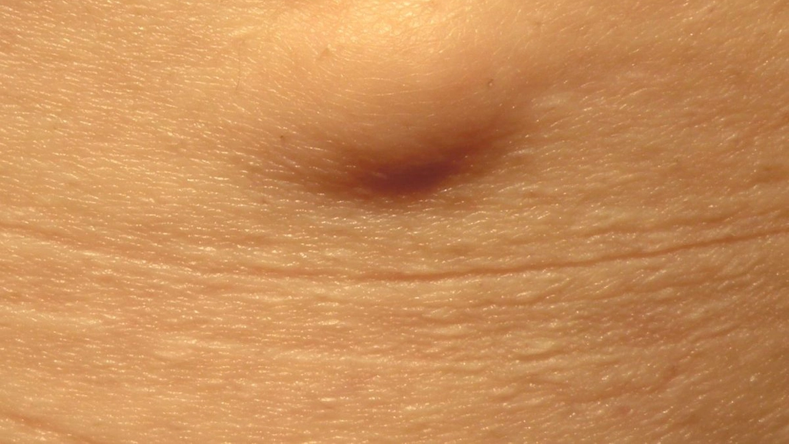 Lipoame de grăsime – poze. Cât de periculoase sunt acestea?