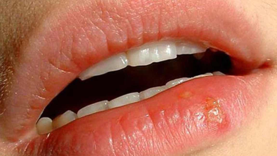 Ce este mononucleoza infecțioasă? Cauze, simptome și tratament
