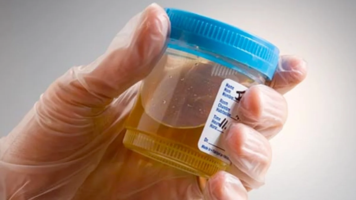 Acid ascorbic în urină. Cum să identifici nivelul acestuia la domiciliu?
