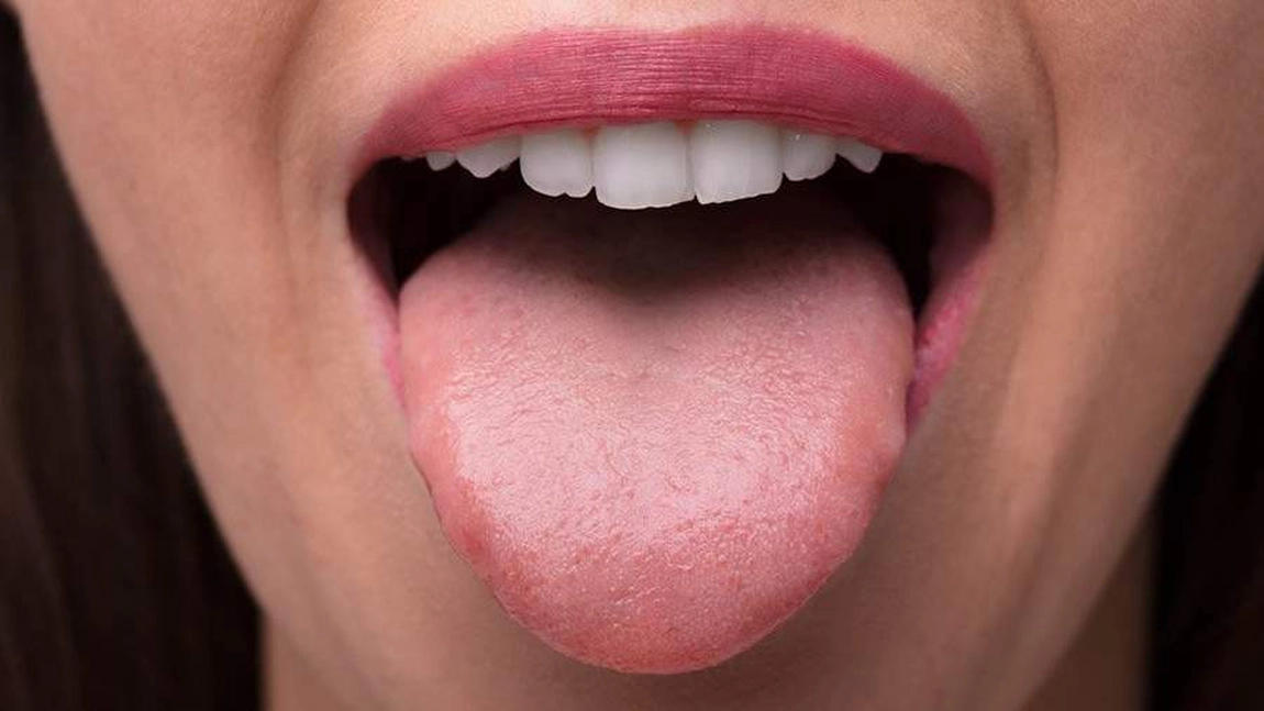 Cancer la limba – poze. Trei metode de tratament recomandate de medici