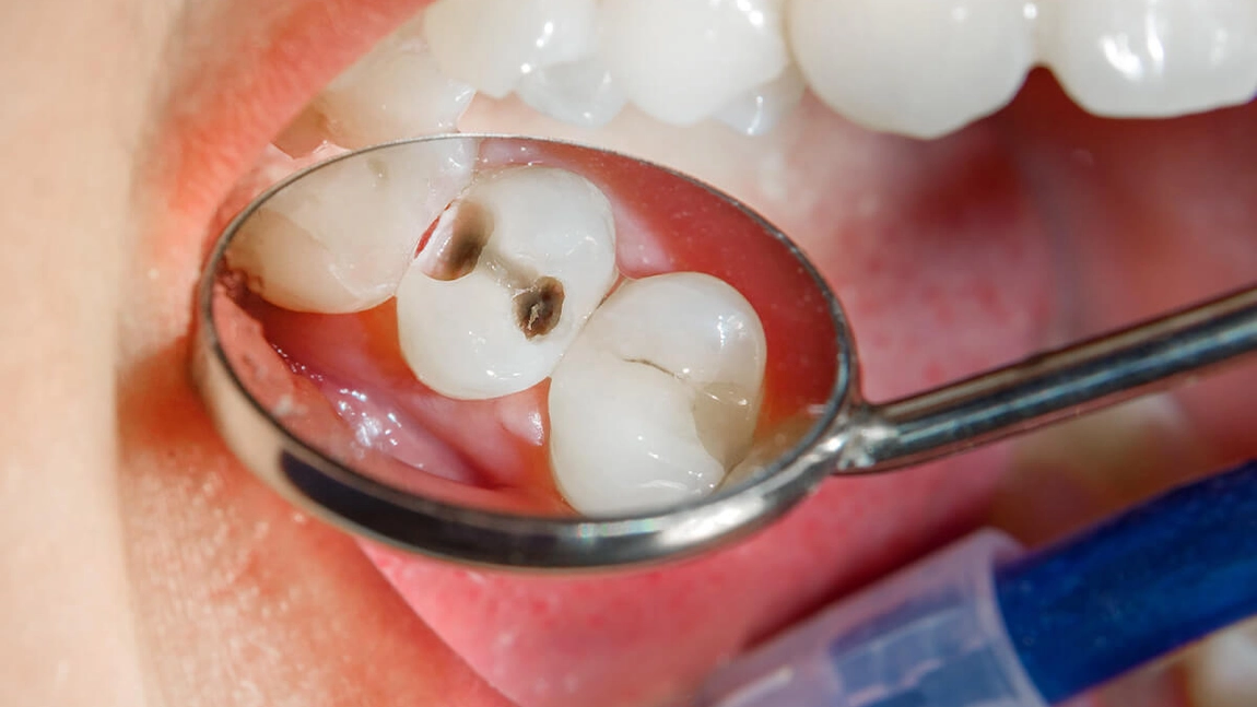 Început de carie. Cum poate fi reparată zona afectată?