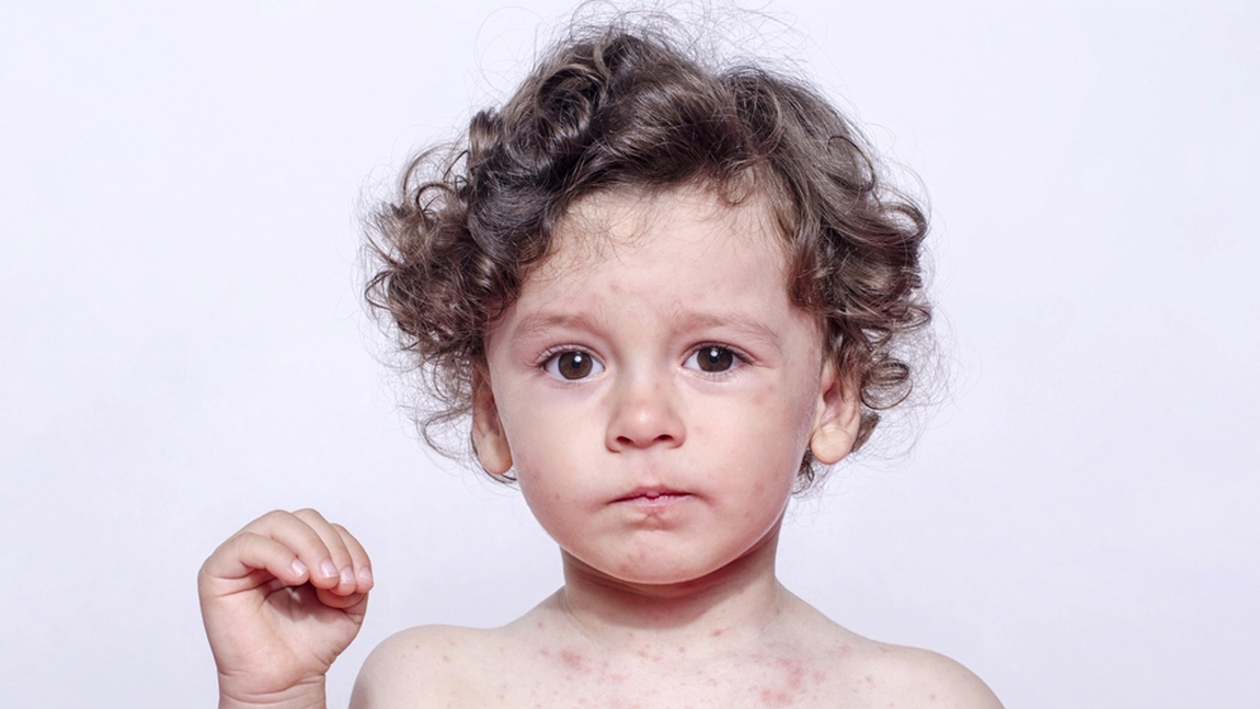 Poze cu pojar mic. În câte zile de la contaminare încep să apară primele semne?