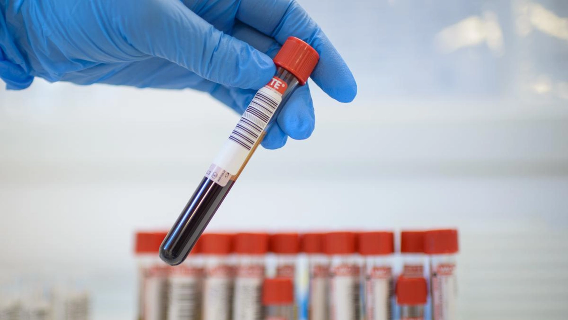 Dacă ai cancer iese în analizele de sânge? Ce teste sunt necesare pentru a detecta această afecțiune?