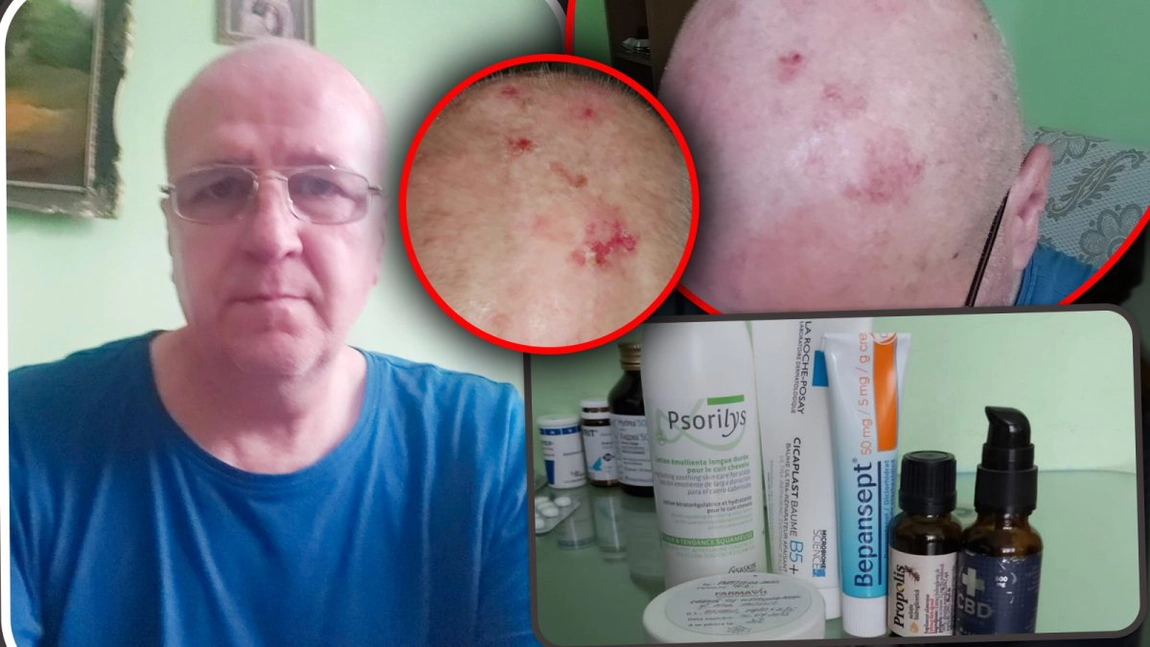 Suferința prin care trece un ieșean! De 15 ani se luptă cu o boală îngrozitoare, iar tratamentul costă o avere: „Apa îmi provoacă dureri greu de imaginat” - FOTO