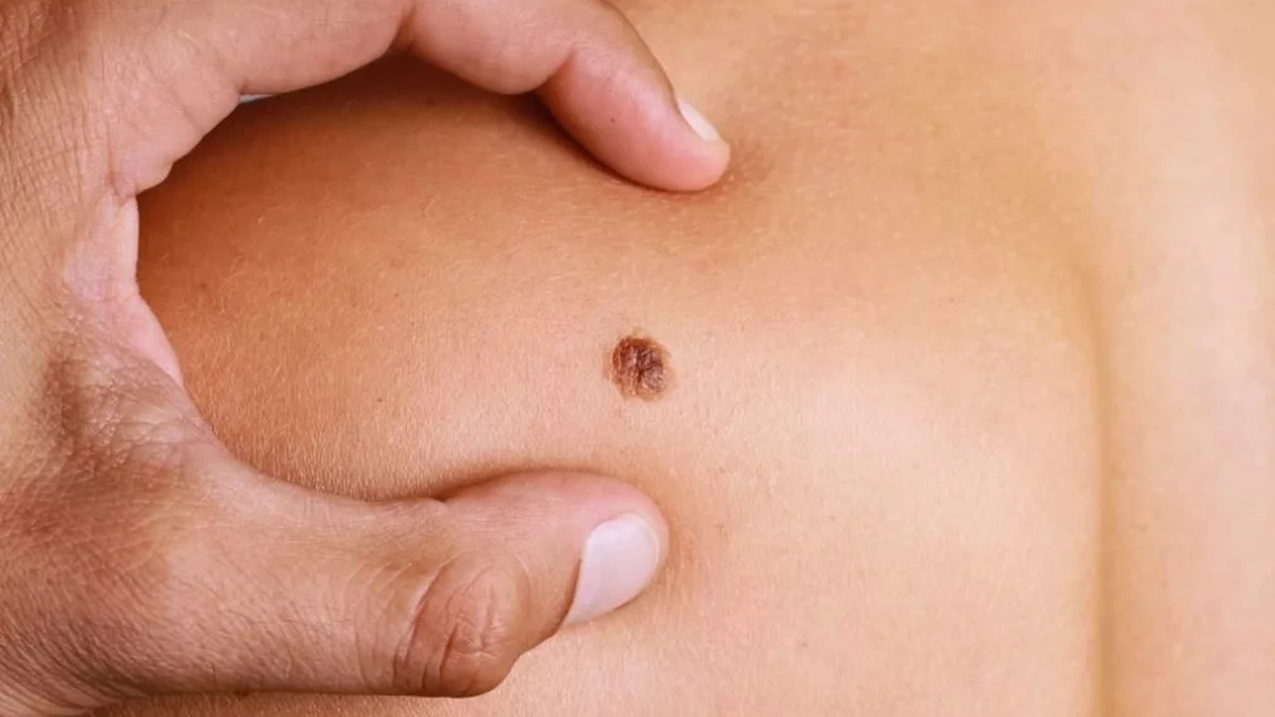 Imagini cu alunițe periculoase. Când acestea devin canceroase?
