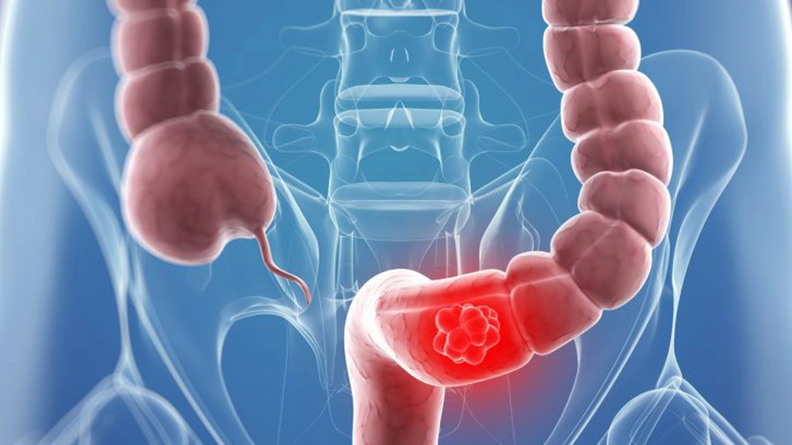 Primul semn al cancerului de colon. Cum se face simțită prezența bolii?