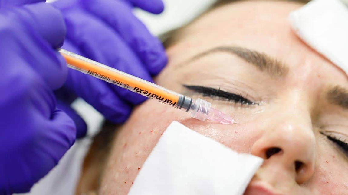 Mezoterapie facială. Scapă de acnee cu ajutorul acestei proceduri