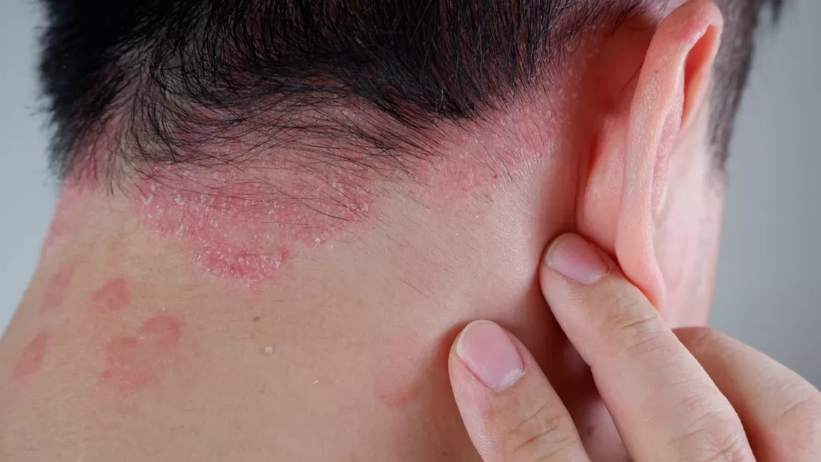 Poze cu dermatita seboreică la scalp. Primele semne care îți indică că suferi de această afecțiune dermatologică