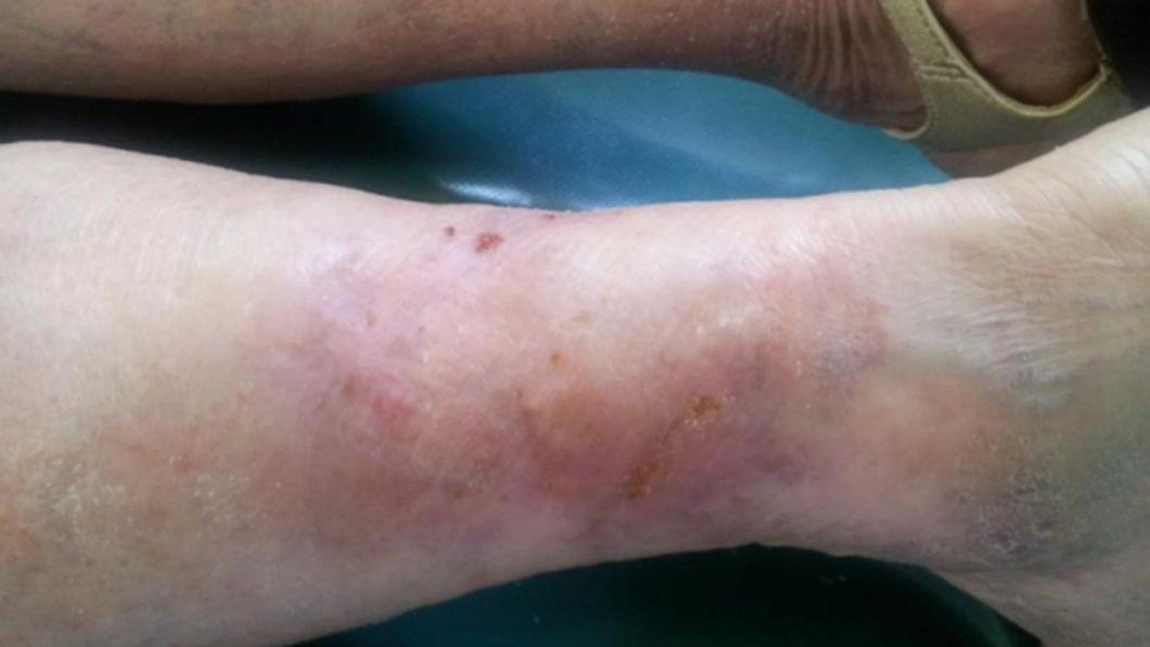 Poze cu ulcer varicos. Cum să gestionezi eficient această problemă de sănătate