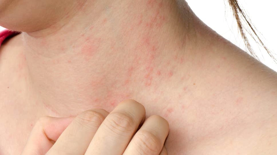 Iritații ale pielii – poze. Ce afecțiuni pot provoca astfel de probleme dermatologice