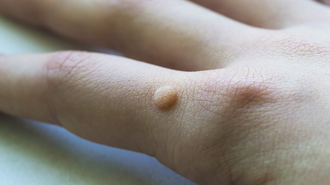 Simptome HPV la femei! Cum putem să recunoaștem prezența virusului