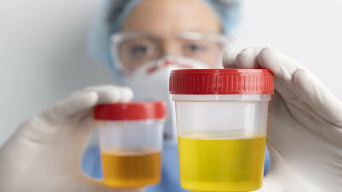 Ce afecțiune anunță celulele epiteliale scuamoase în urină? Ce înseamnă detectarea acestora în timpul unei analize de rutină