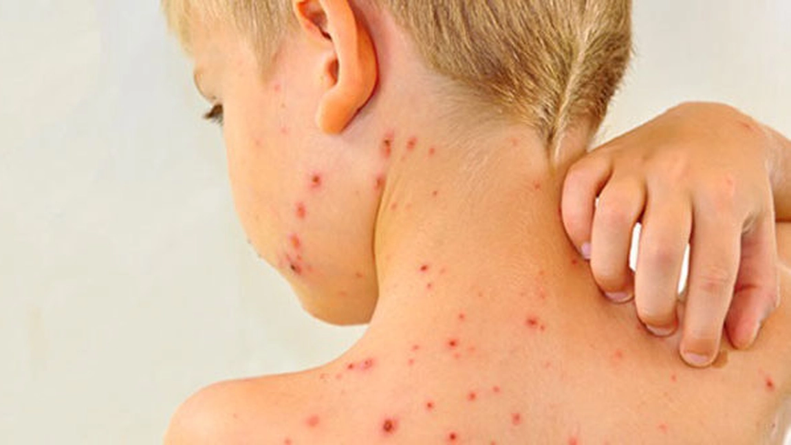 Ministerul Sănătății declară epidemie de rujeolă în România: 