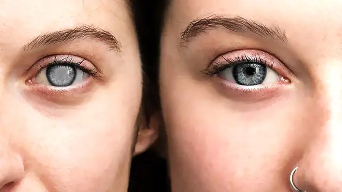 Recomandări după operația de cataractă. Cum să eviți infecțiile și să grăbești procesul de vindecare