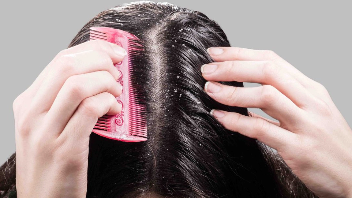 Tratament pentru mătreață acasă. Rezultatele apar la scurt timp!