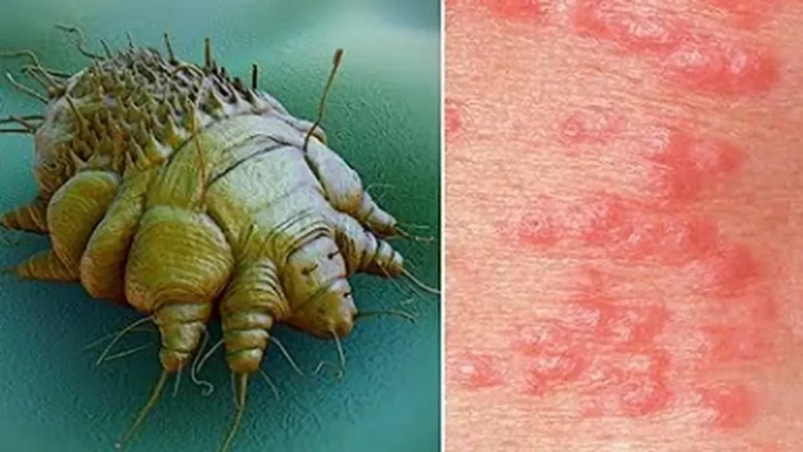Alertă epidemiologică într-un liceu! Specialiștii au confirmat infectarea cu râie