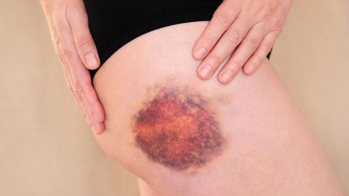 Diferența dintre un hematom sub piele și o vânătaie. Când e cazul să mergi la medic