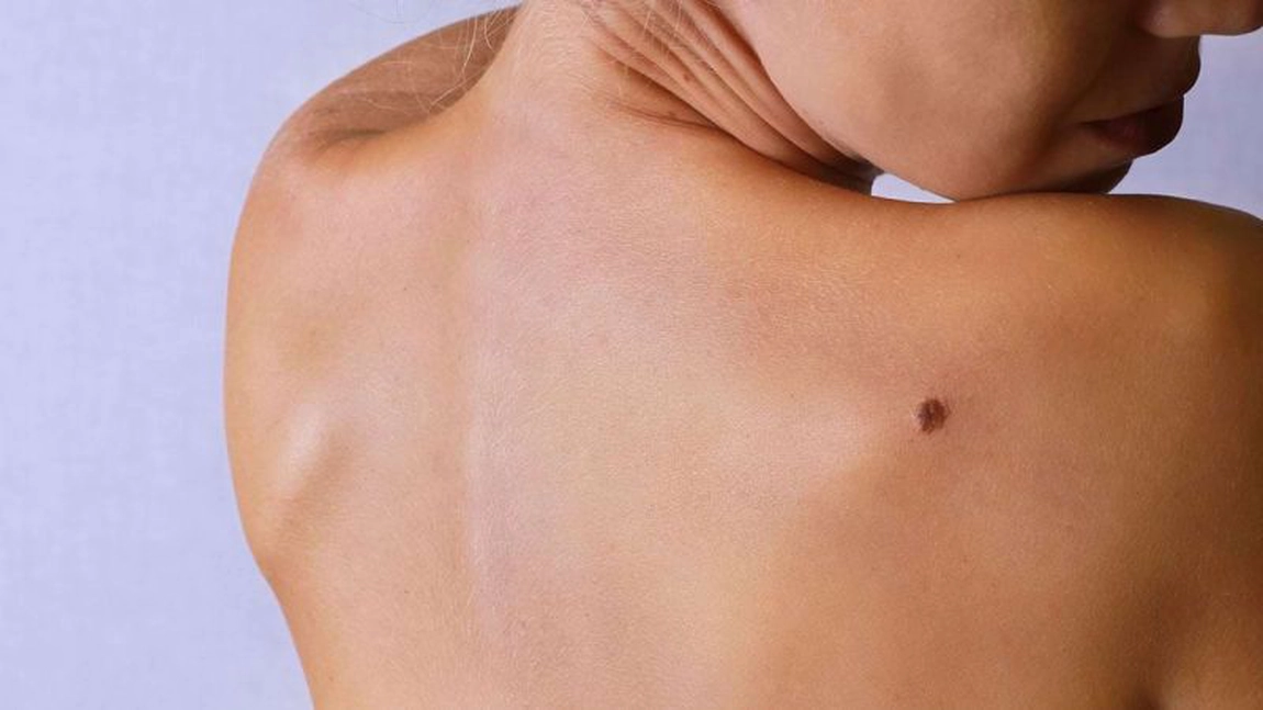 Alunițe canceroase. Cum se deosebesc și ce trebuie să facem ca să evităm cancerul de piele