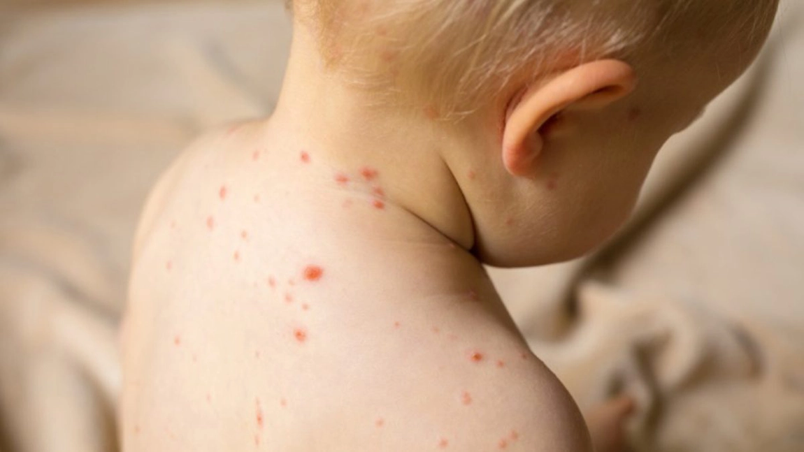 Medicii ieșeni trag un semnal de alarmă după ce un bebeluș de 8 luni a murit din cauza rujeolei: „Rata de vaccinare împotriva acestei patologii a scăzut extrem de mult”