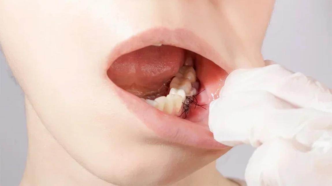 Grefa gingivală – ce este și cum îmbunătățește sănătatea gingivală?