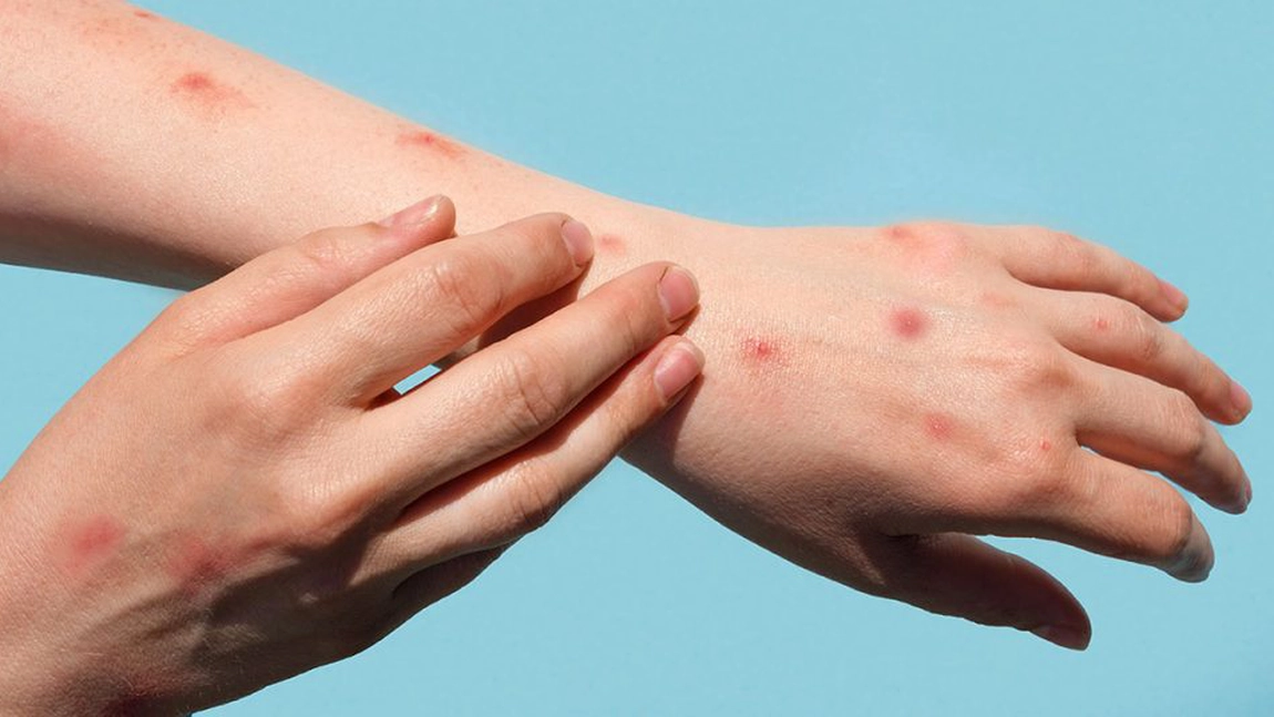 Noua tulpină a mpox dă fiori cercetătorilor. Virusul este mai contagios decât s-a preconizat