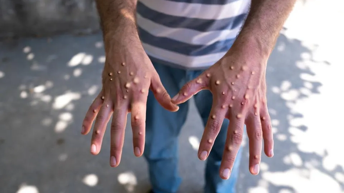 OMS declară epidemia de mpox, cunoscută ca „variola maimuței”, urgență de sănătate globală