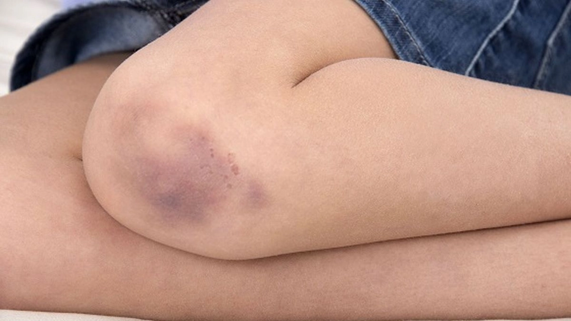De ce apar vânătăi pe picioare fără să te lovești? Cauze și metode de prevenție
